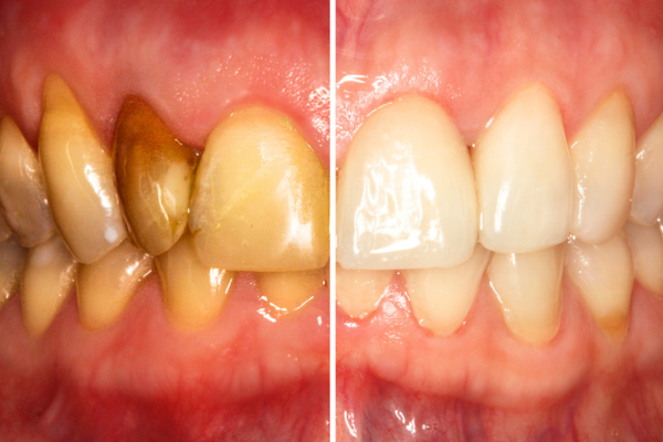 Gum-Disease-and-Scaling