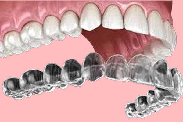 teeth aligners