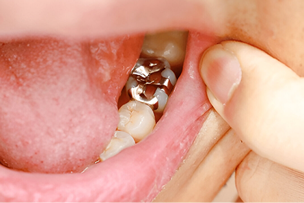 dental cavity and filling