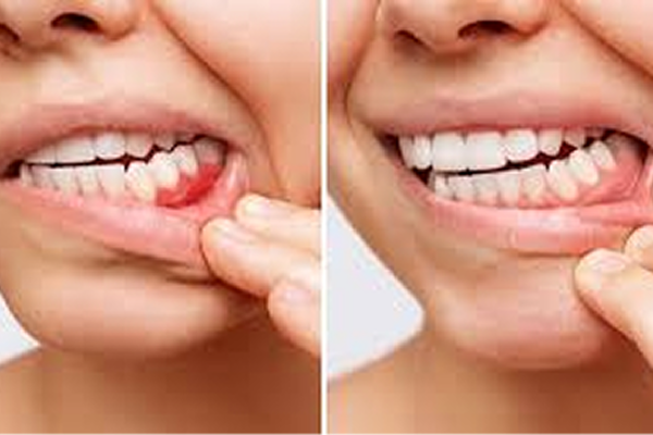 dental gum treatment