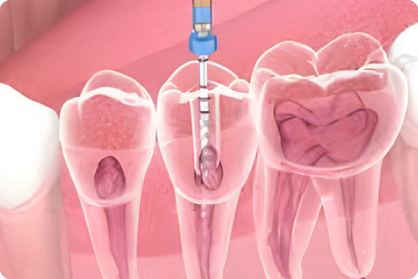 Root Canal Treatment