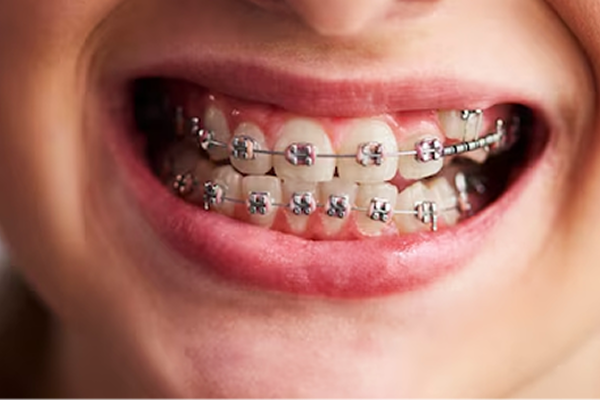 teeth alignment treatment